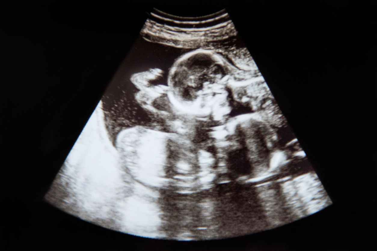 Obstetrical Malpractice